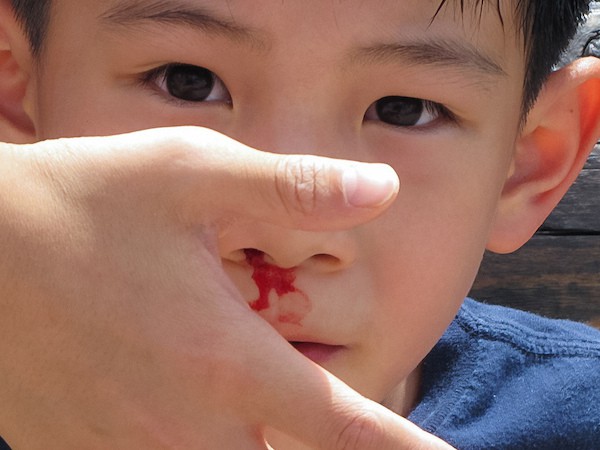 носовые кровотечения у детей
