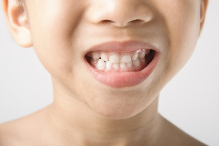 пятна на детских зубах
