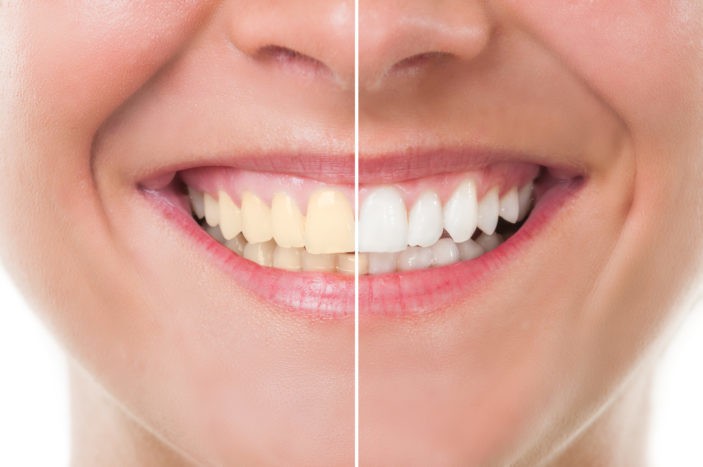 Побочные эффекты отбеливания зубов при отбеливании