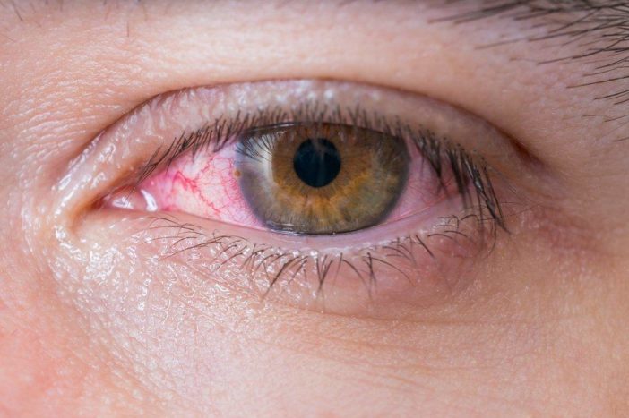 аллергический конъюнктивит красных глаз
