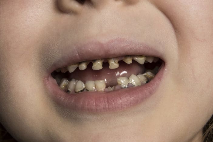 кариес зубов для детской кариеса