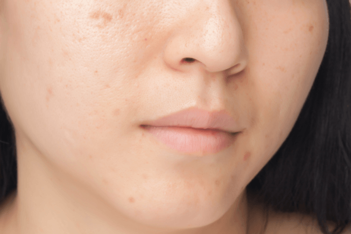 способ удаления шрамов на лице