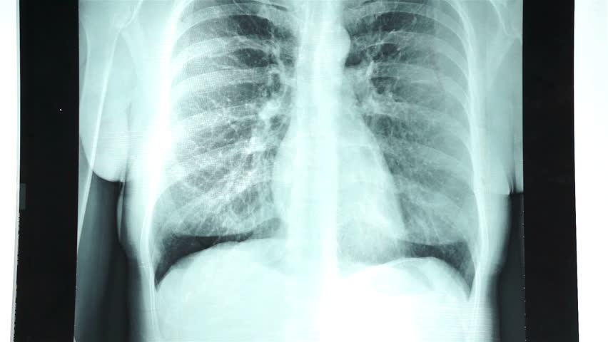 рентгенография грудной клетки