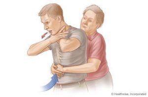 Шаги, помогающие душить людей (источник: webmd.com)