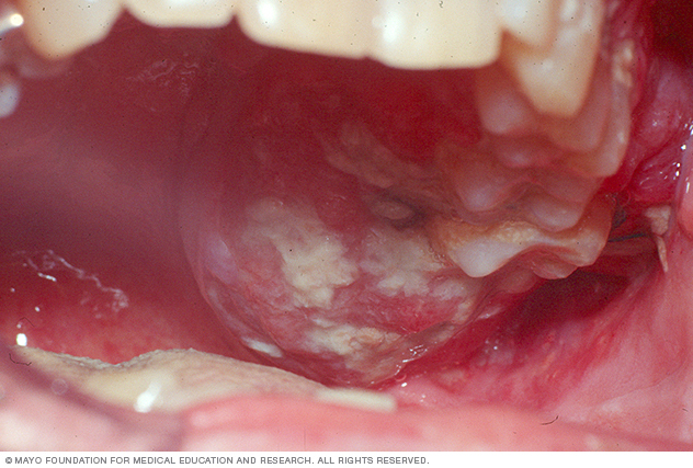 рак полости рта