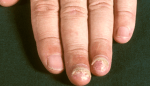 ломкие ногти