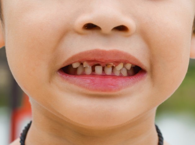 повреждение детских зубов