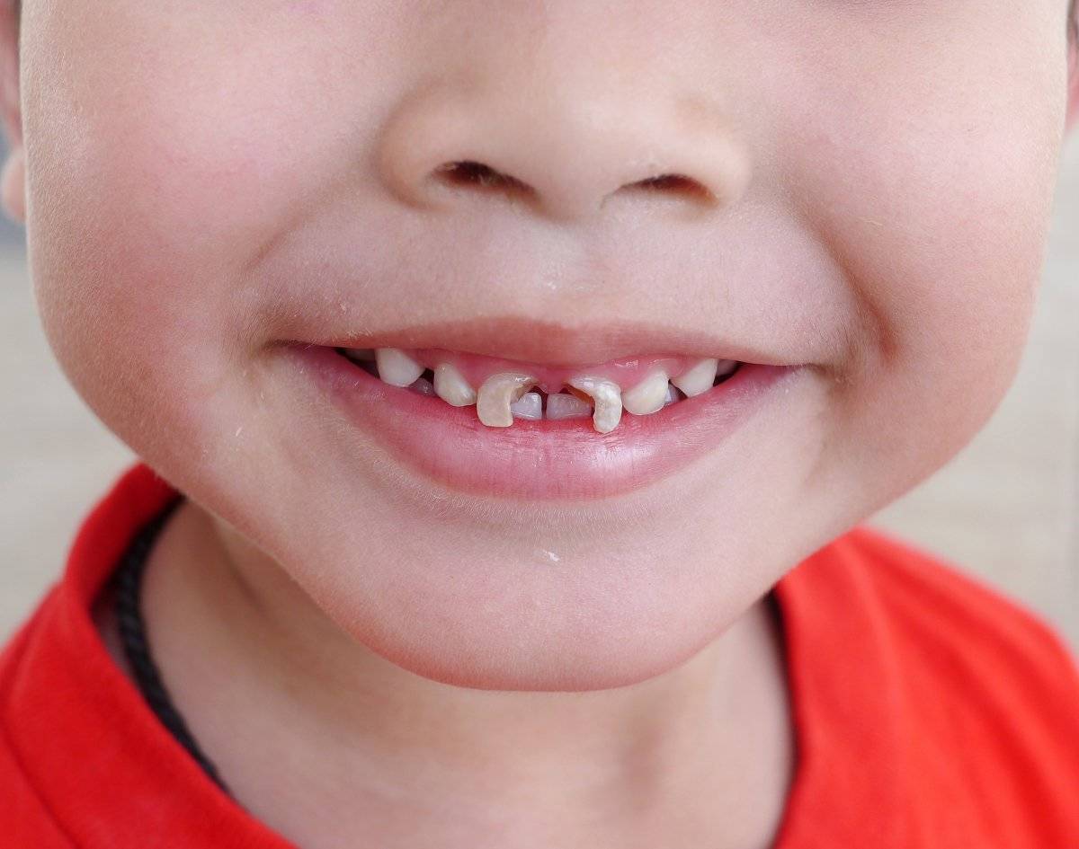 Ребенок 3 года не растет. Кариес передних зубов у детей. Кариес передних молочных зубов. Кариес передних молочных зубов у ребенка.