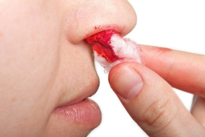 причины носовых кровотечений, носовые кровотечения у детей, носовые кровотечения, внезапные носовые кровотечения