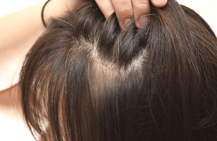 предотвратить седые волосы в молодом возрасте
